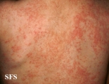 miliaria
