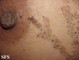 naevus comedonicus