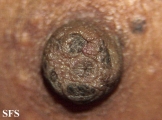 naevus comedonicus