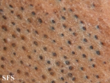 naevus comedonicus