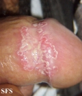 balanitis-circinate erosive balanitis