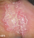 balanitis-circinate erosive balanitis