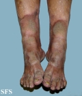 progressive palmoplantar keratoderma