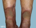 progressive palmoplantar keratoderma