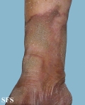 progressive palmoplantar keratoderma