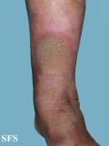 progressive palmoplantar keratoderma