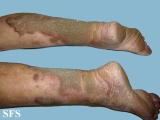 progressive palmoplantar keratoderma
