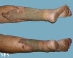 progressive palmoplantar keratoderma