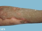 progressive palmoplantar keratoderma