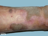 progressive palmoplantar keratoderma
