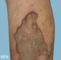 progressive palmoplantar keratoderma