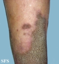 progressive palmoplantar keratoderma