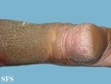 progressive palmoplantar keratoderma