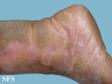 progressive palmoplantar keratoderma