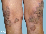 progressive palmoplantar keratoderma