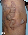 progressive palmoplantar keratoderma