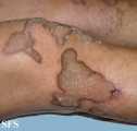 progressive palmoplantar keratoderma