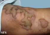 progressive palmoplantar keratoderma