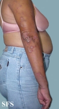 progressive palmoplantar keratoderma