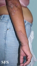 progressive palmoplantar keratoderma