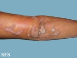 progressive palmoplantar keratoderma