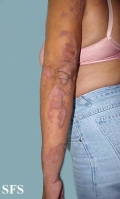 progressive palmoplantar keratoderma