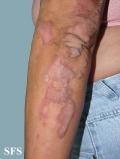 progressive palmoplantar keratoderma