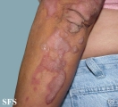 progressive palmoplantar keratoderma