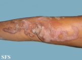 progressive palmoplantar keratoderma
