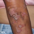 progressive palmoplantar keratoderma