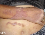 progressive palmoplantar keratoderma