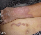progressive palmoplantar keratoderma