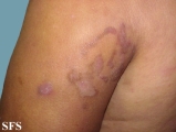 progressive palmoplantar keratoderma