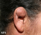 pseudocyst of the ear