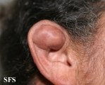 pseudocyst of the ear