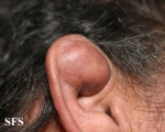 pseudocyst of the ear