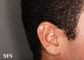 pseudocyst of the ear