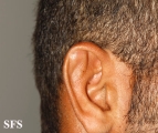 pseudocyst of the ear