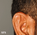 pseudocyst of the ear