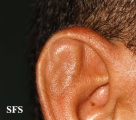 pseudocyst of the ear