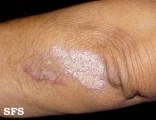 psoriasis