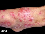 psoriasis