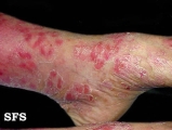 psoriasis