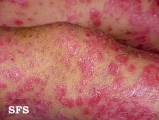 psoriasis