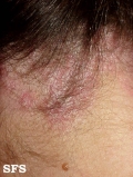 psoriasis