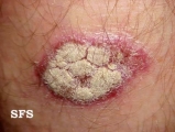 psoriasis