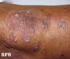 psoriasis