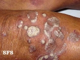 psoriasis