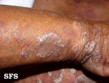 psoriasis