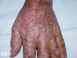 psoriasis